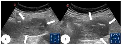 Small bowel adenocarcinoma of the jejunum detected by double contrast enhanced ultrasound: a case report of a novel ultrasound modality